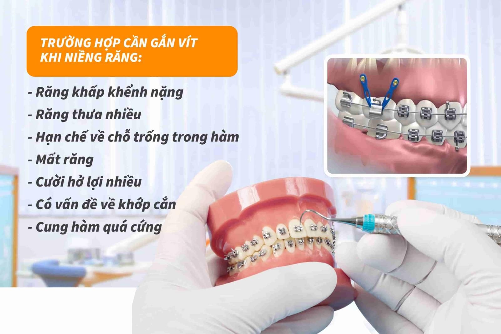 Trường hợp nào cần gắn vít khi niềng răng?