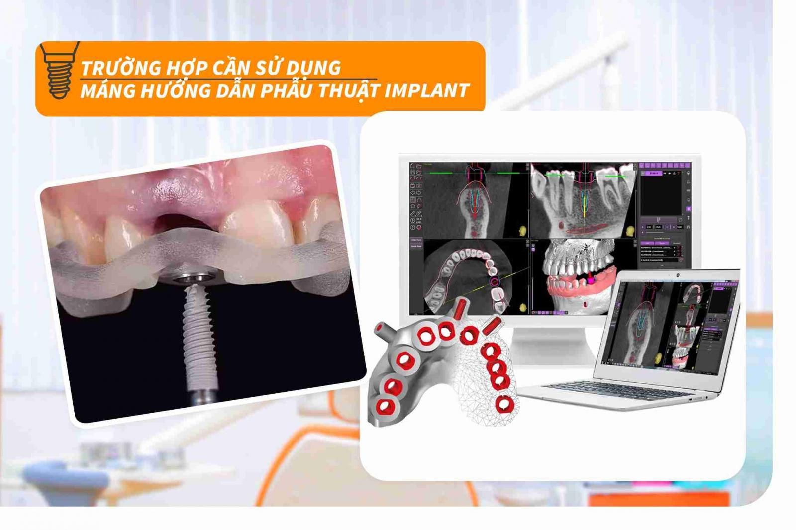 Trường hợp cần sử dụng máng hướng dẫn phẫu thuật Implant  