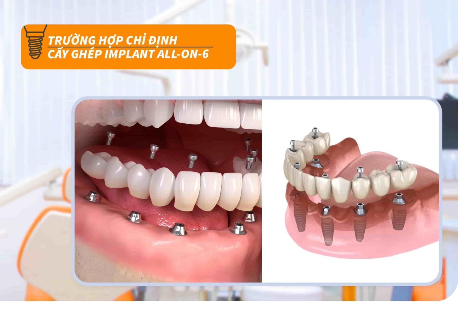 Trường hợp chỉ định cấy ghép Implant all-on-6