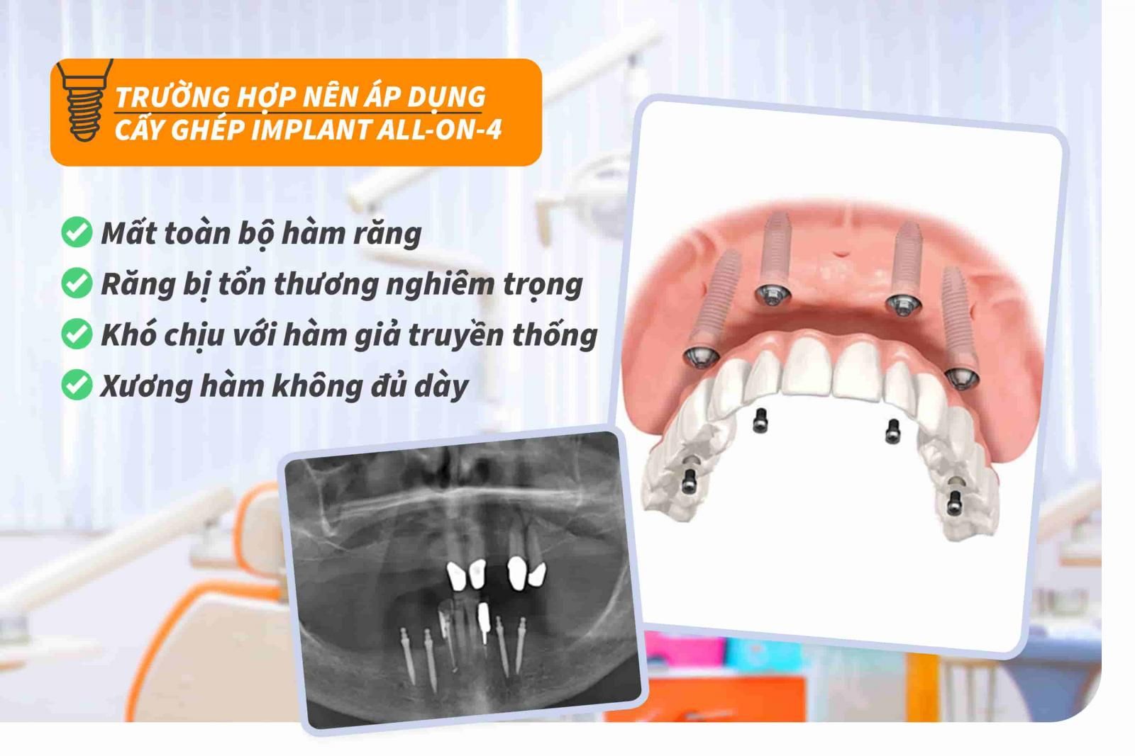 Trường hợp nào nên áp dụng cấy ghép Implant All-on-4?