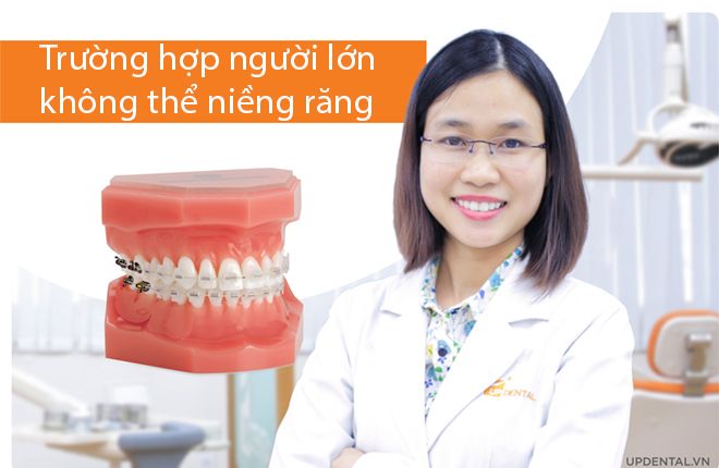 trường hợp người lớn không thể niềng răng