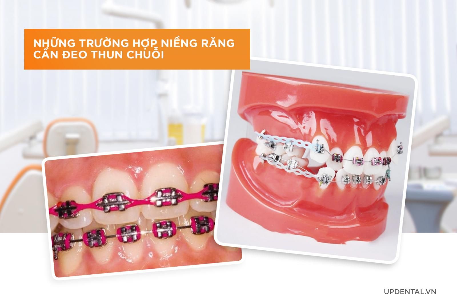 Những trường hợp đeo chun chuỗi khi niềng răng