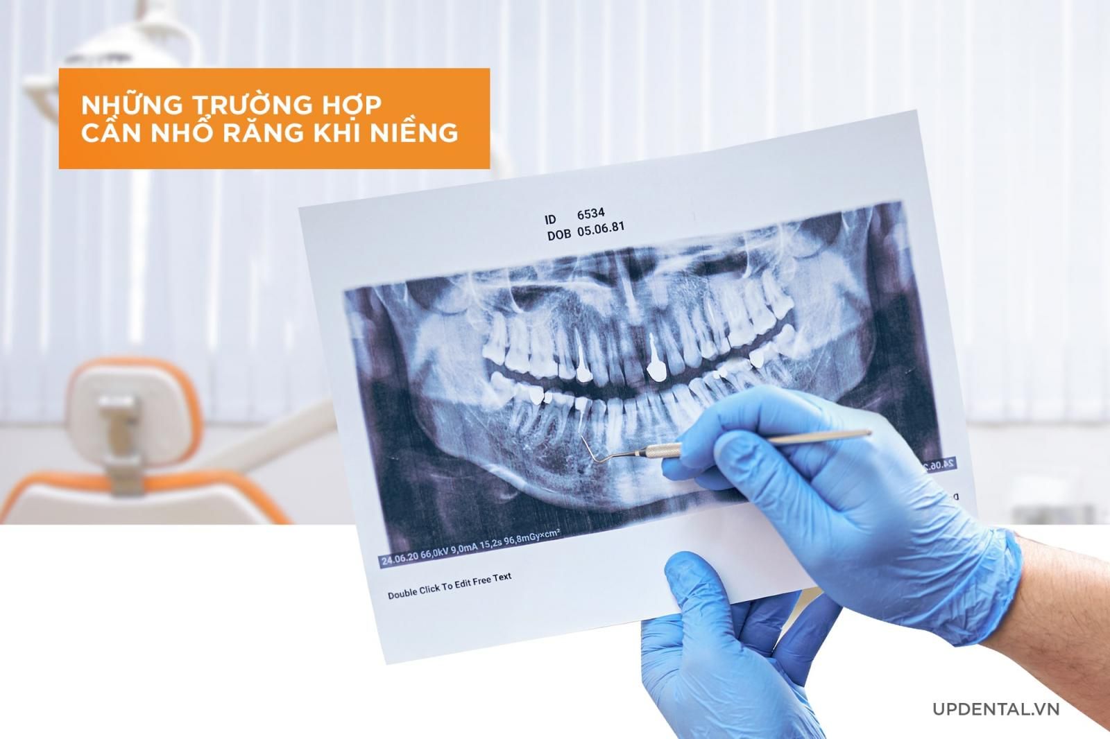 Trường hợp nhổ răng khi niềng