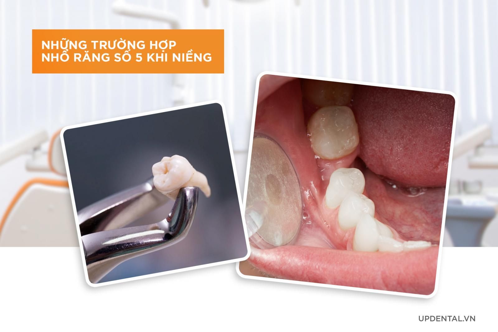 Những trường hợp nhổ răng số 5 khi niềng