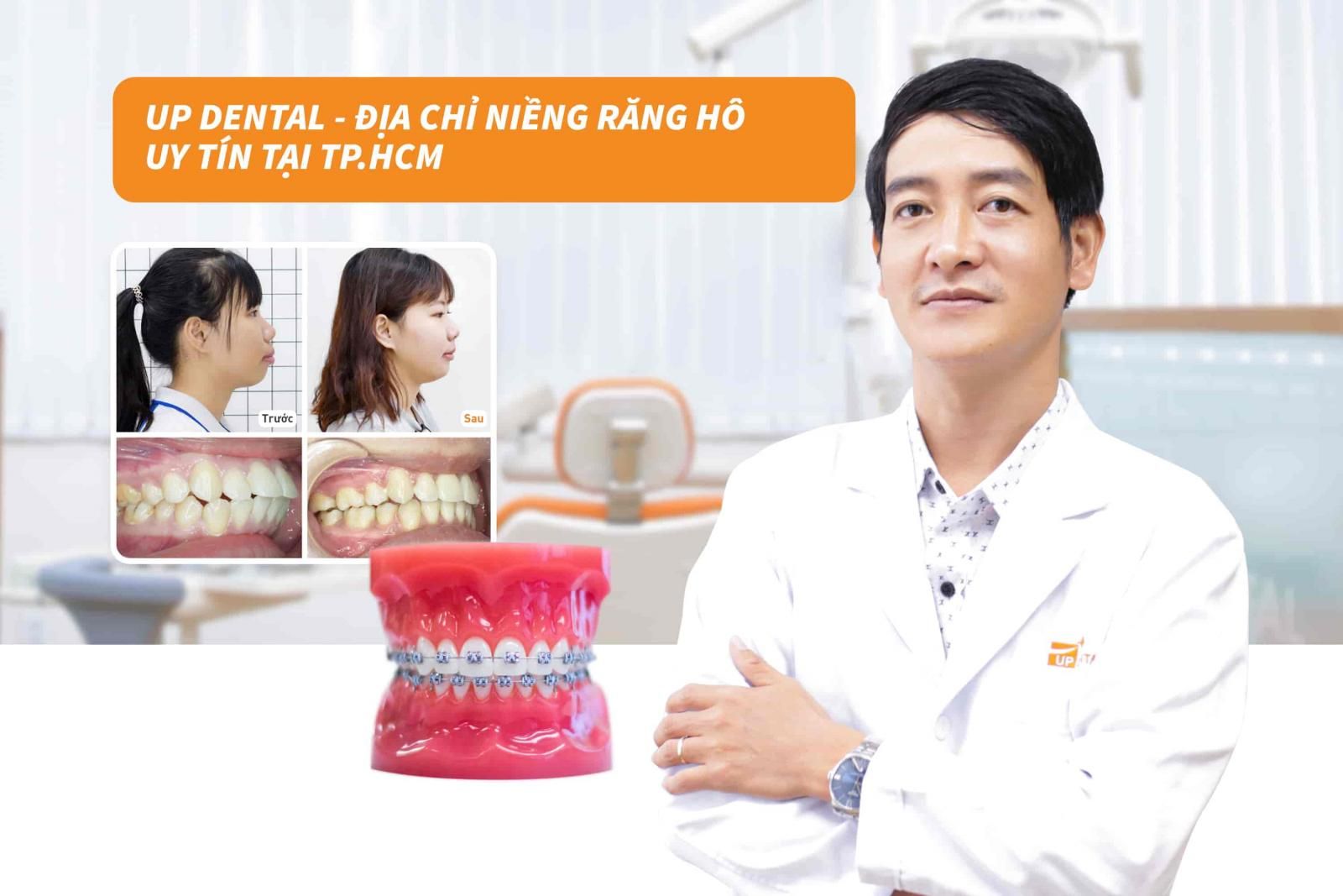 Up Dental - Địa chỉ niềng răng hô uy tín tại TP.HCM