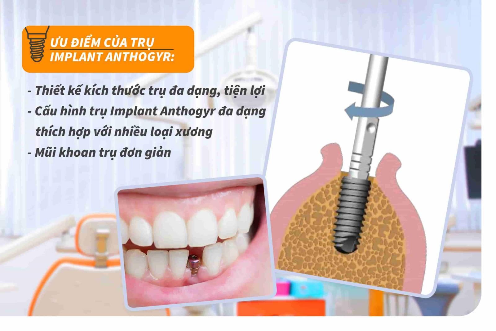 Ưu điểm của trụ Implant Anthogyr