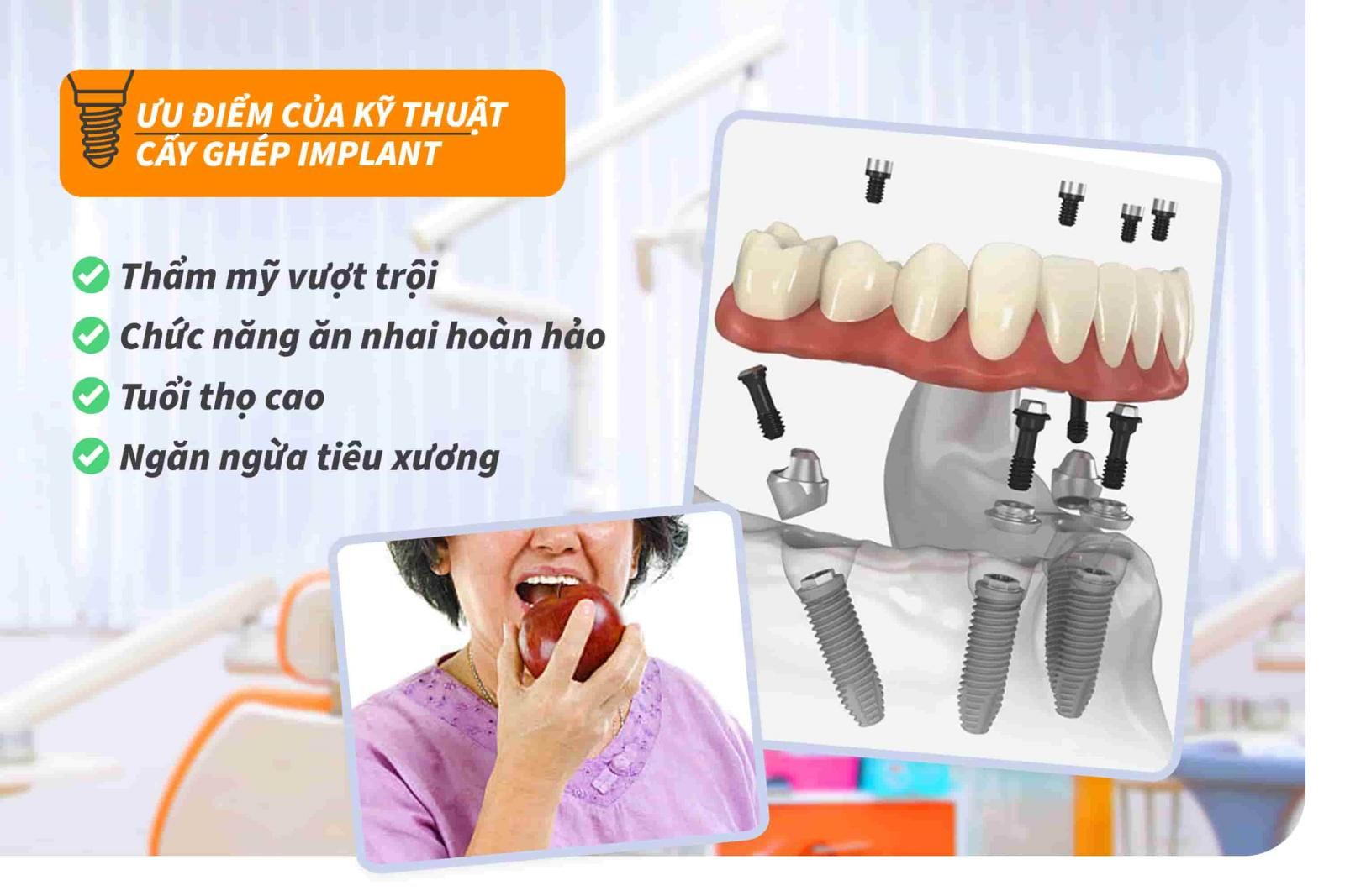 Ưu điểm của kỹ thuật cấy ghép Implant