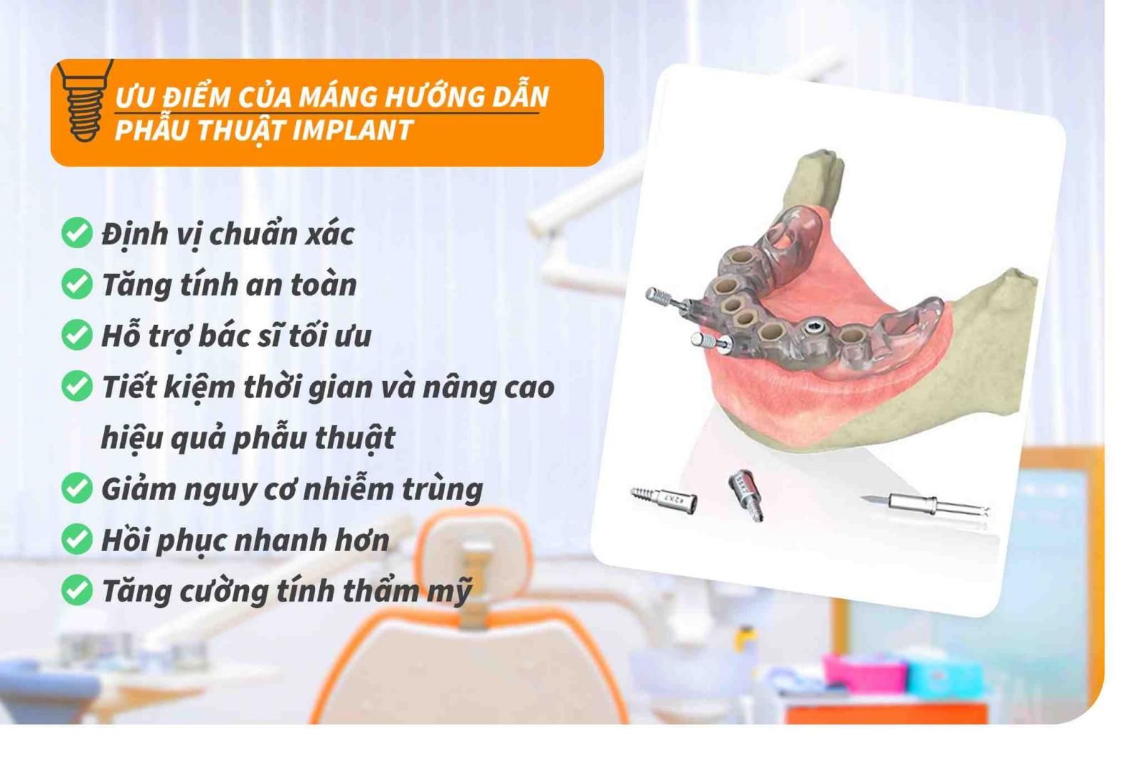 Ưu điểm của máng hướng dẫn phẫu thuật Implant