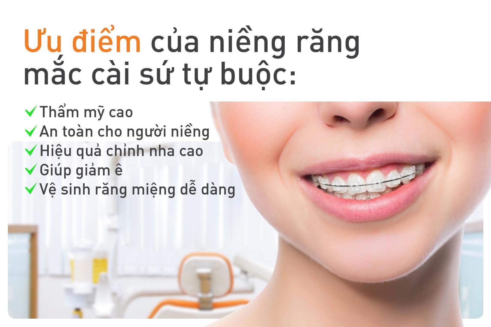 ưu điểm của niềng răng mắc cài sứ tự buộc