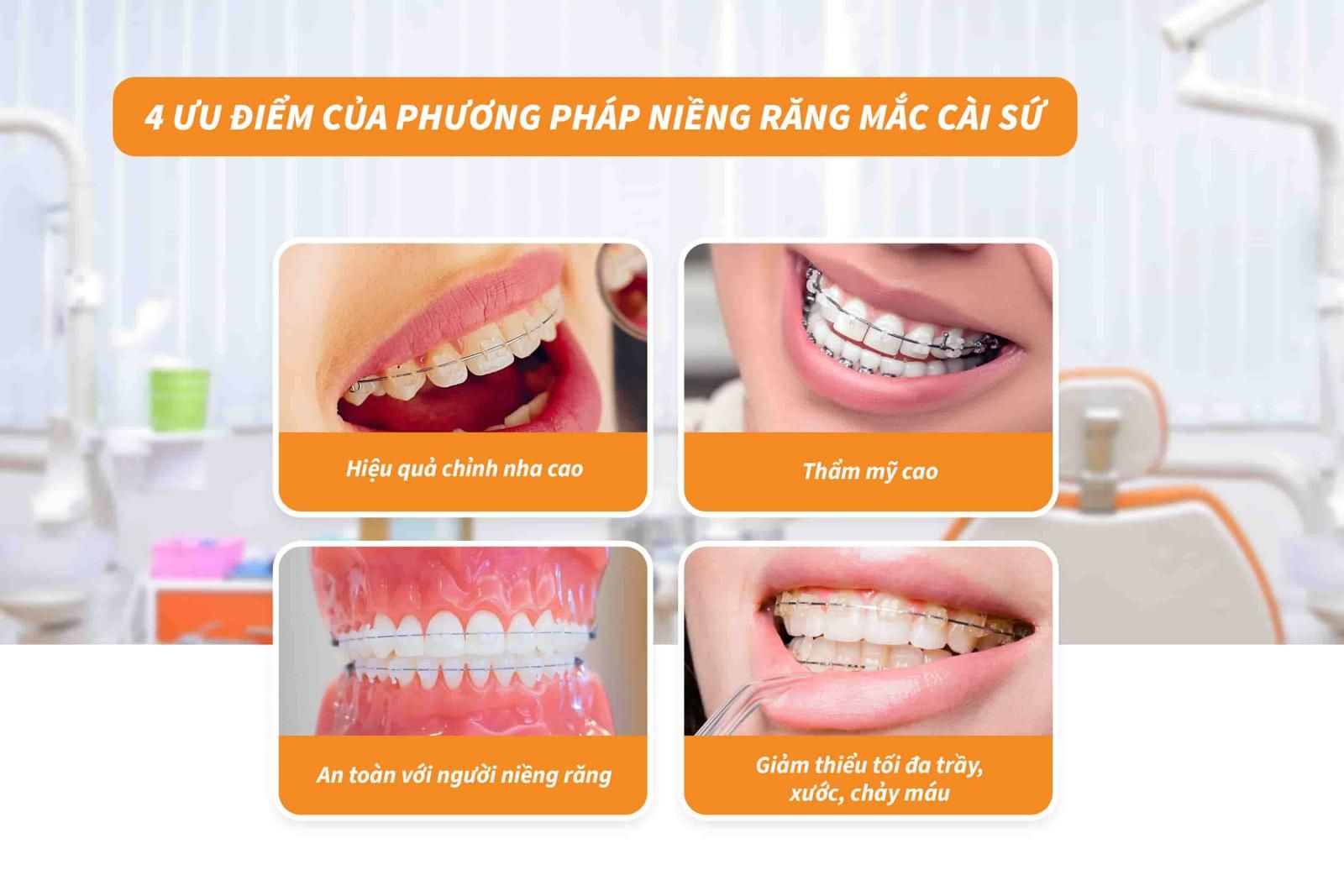 04 điểm nổi bật của phương pháp niềng răng mắc cài sứ