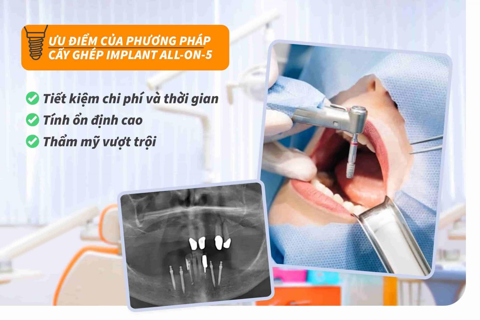 Ưu điểm của phương pháp cấy ghép Implant all-on-5