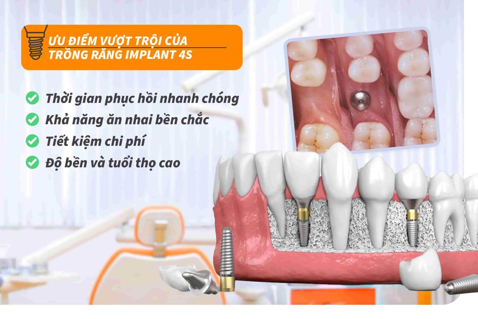 Ưu điểm của trồng răng Implant 4S