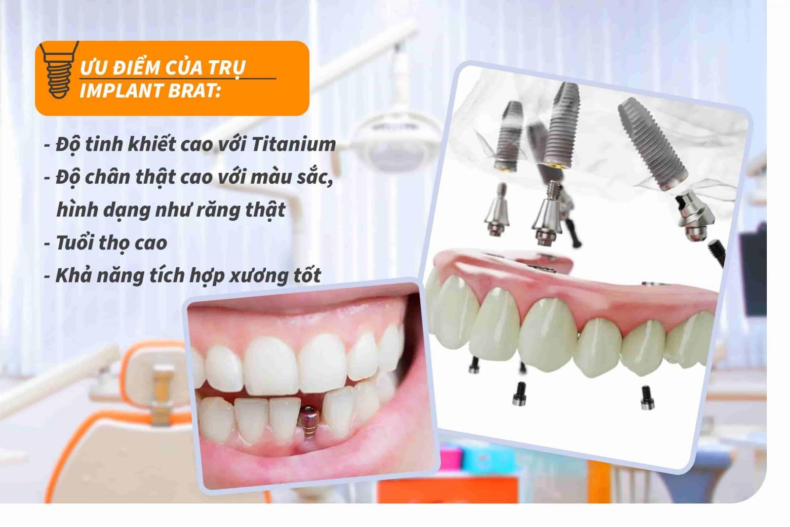 Ưu điểm của trụ Implant Brat