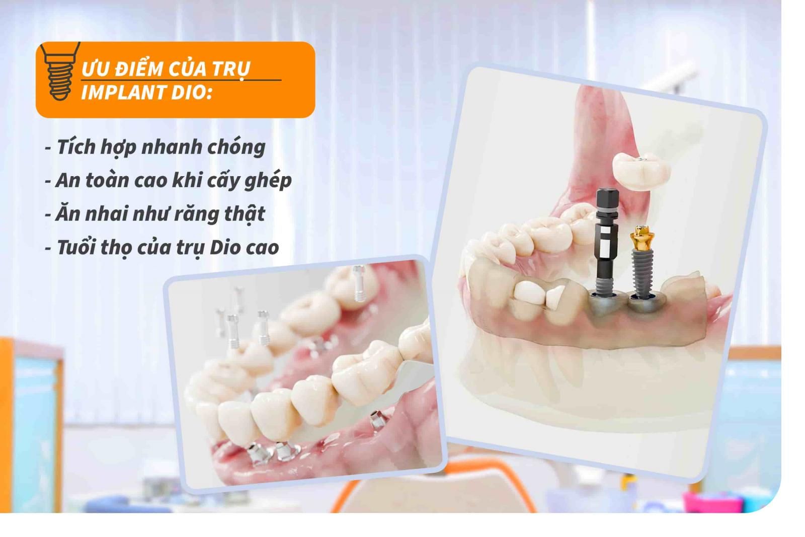 4 ưu điểm của trụ Implant Dio