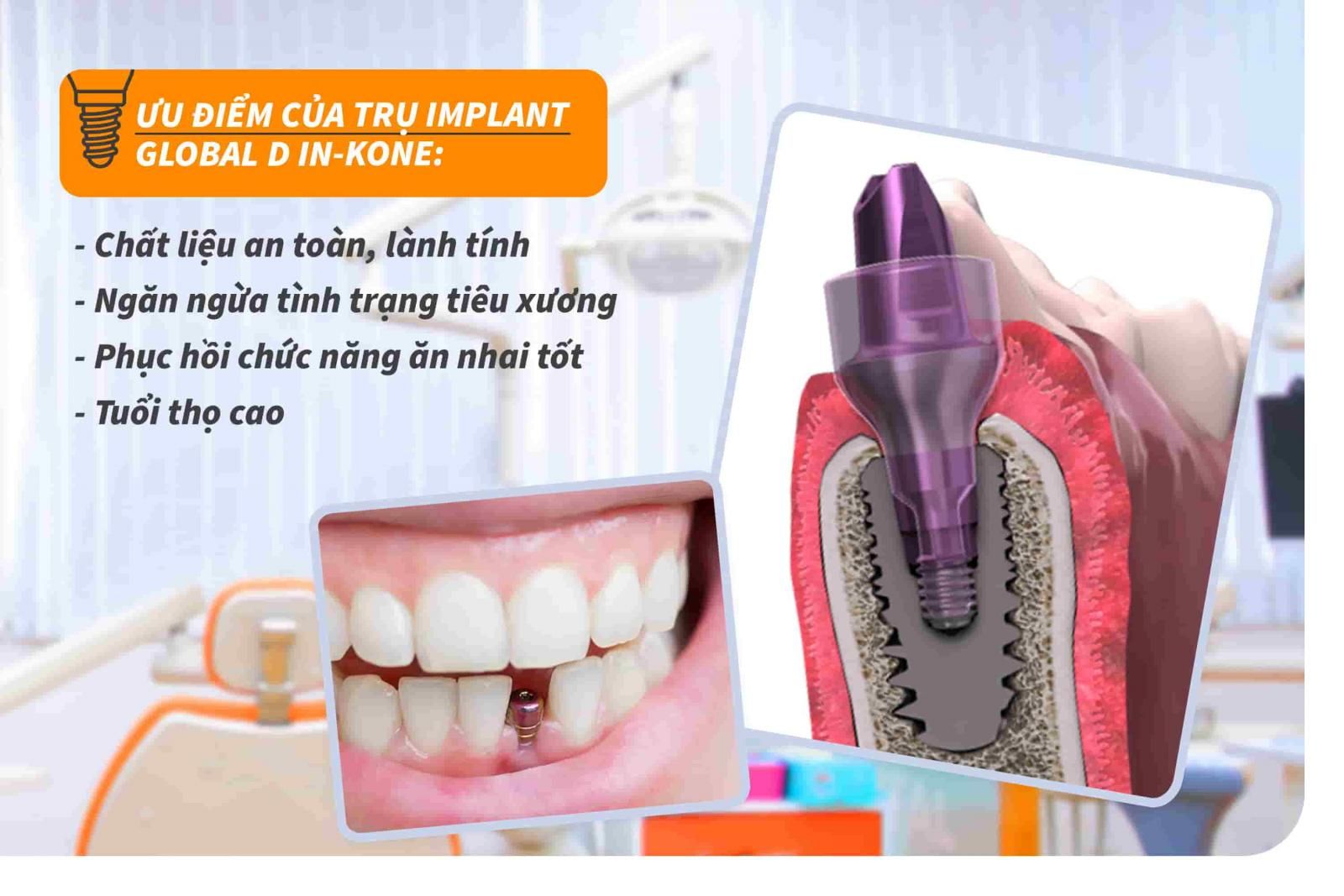 Ưu điểm của trụ Implant Global D In-Kone