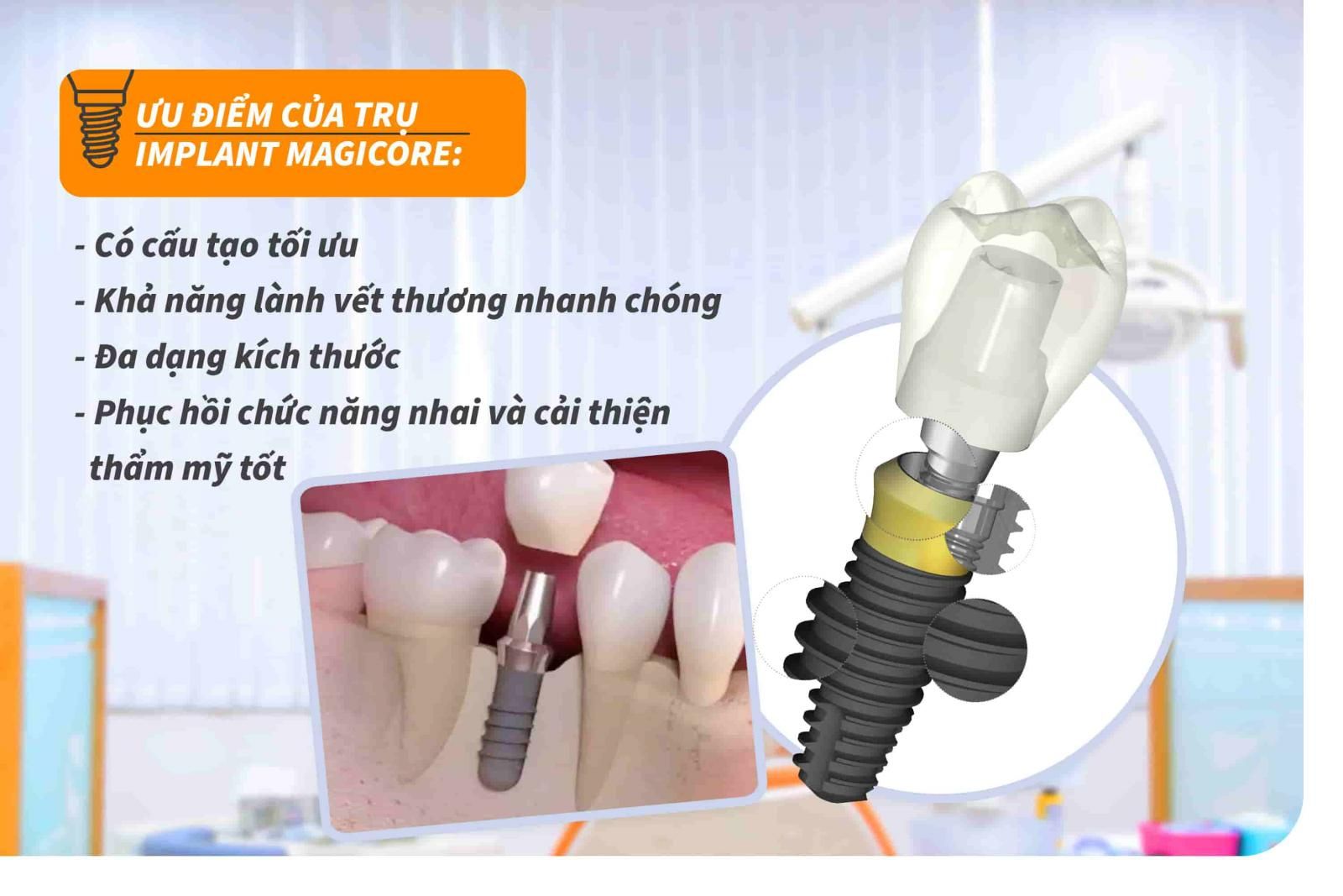 Ưu điểm của trụ Implant Magicore