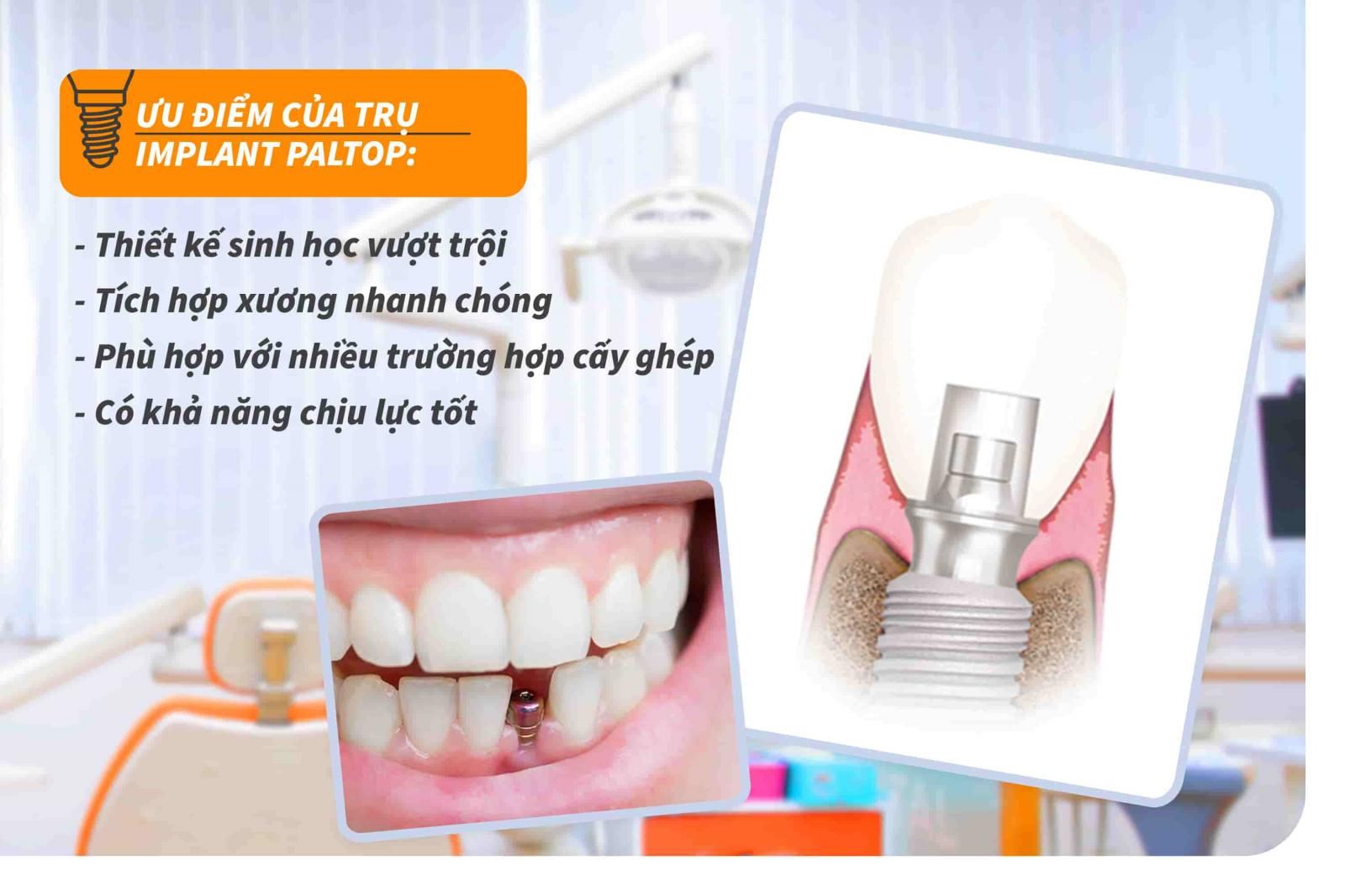 Ưu điểm của trụ Implant Paltop