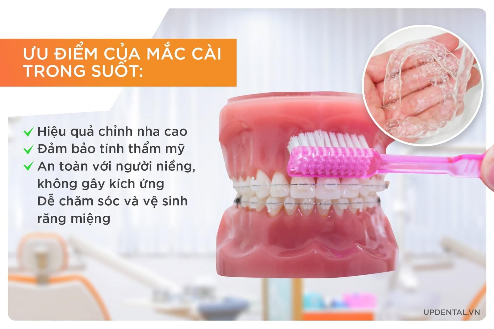 Ưu điểm của niềng răng mắc cài trong suốt