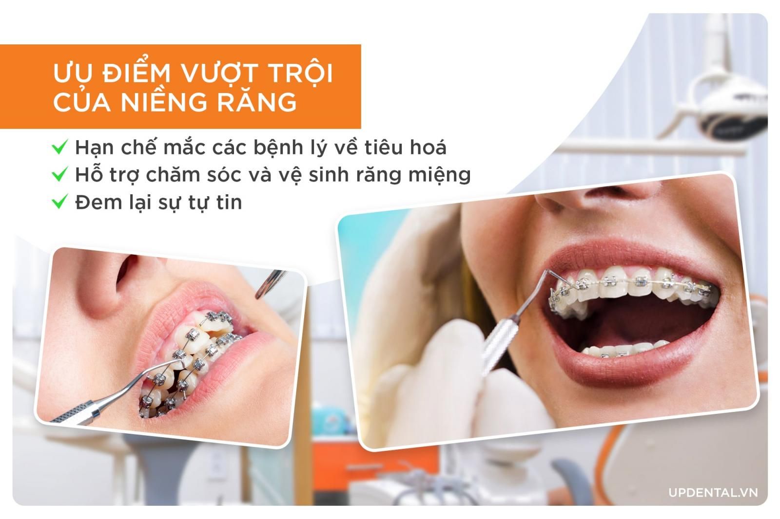 ưu điểm vượt trội của niềng răng