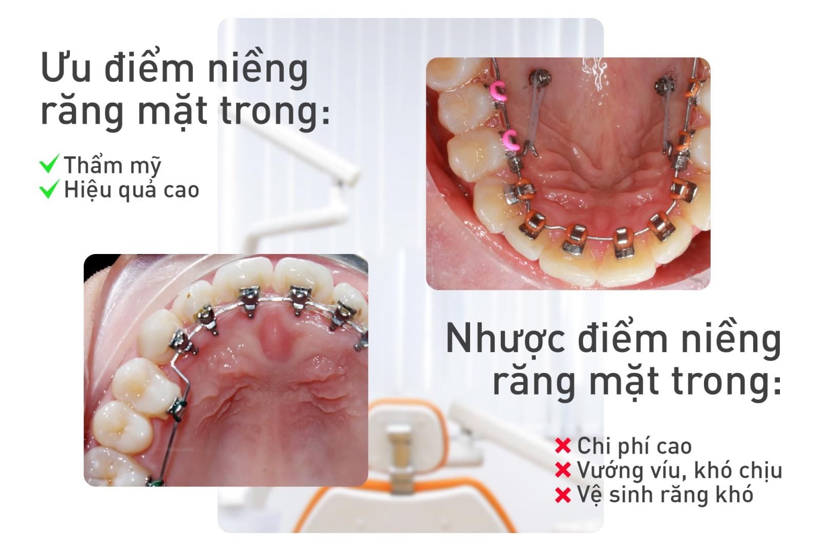 ưu nhược điểm niềng răng mặt trong