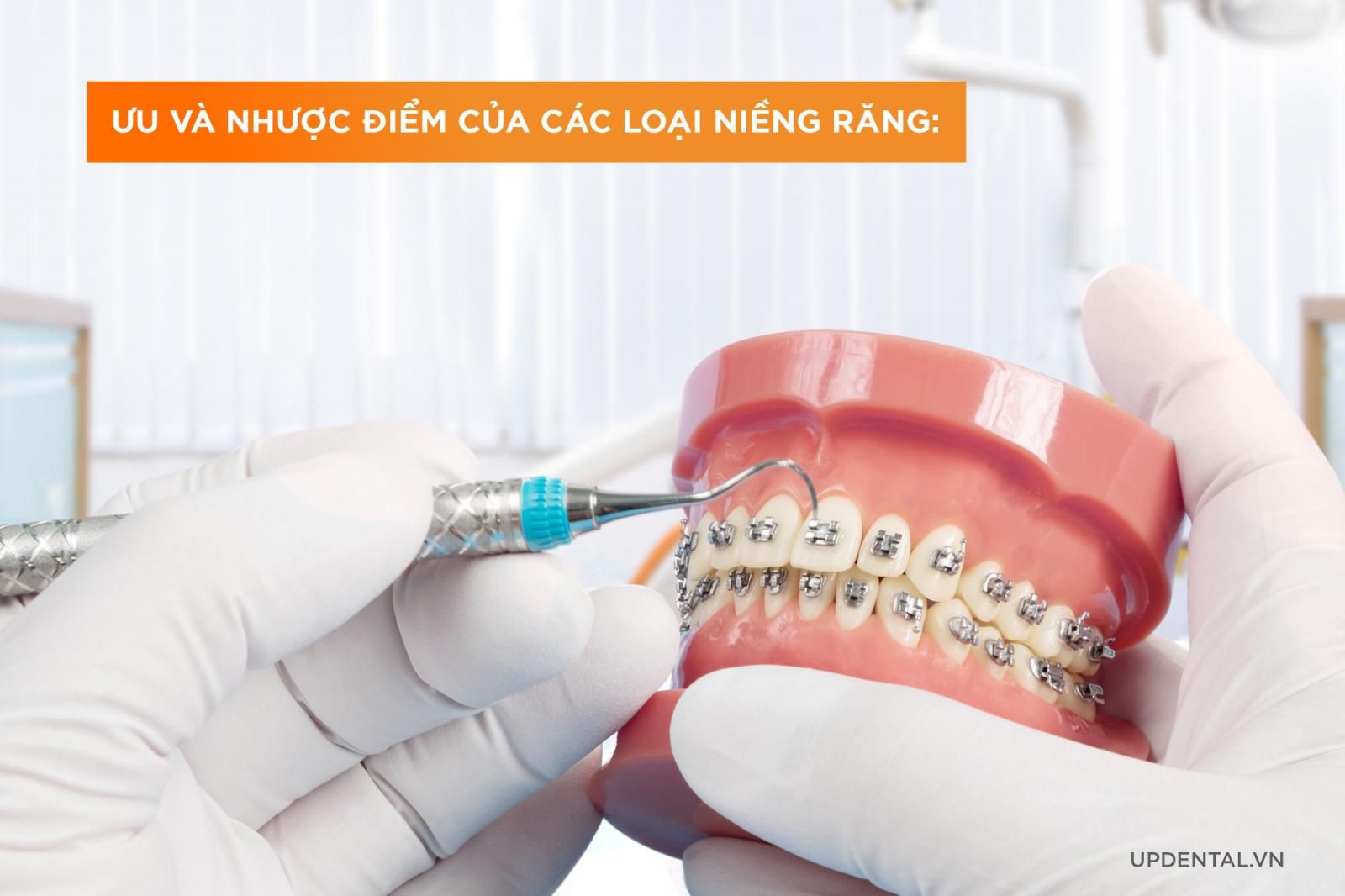 Ưu và nhược điểm của các loại niềng răng