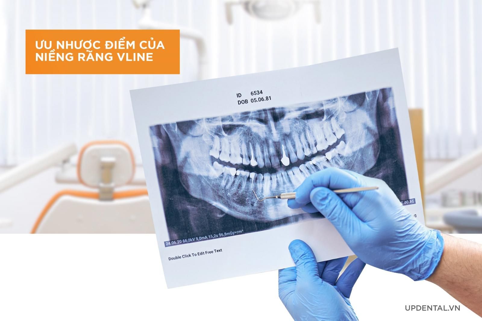 Ưu nhược điểm của niềng răng Vline