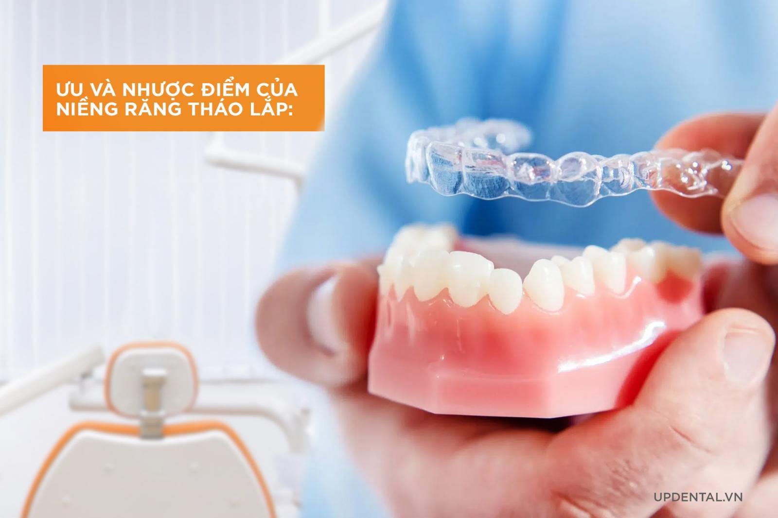 Ưu nhược điểm của niềng răng tháo lắp