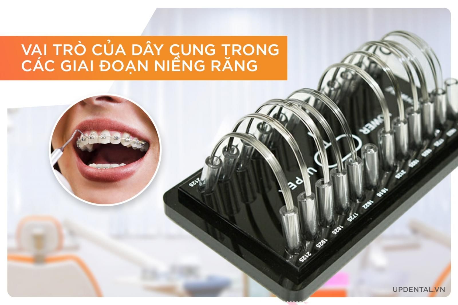 Vai trò cùa dây cung trong niềng răng