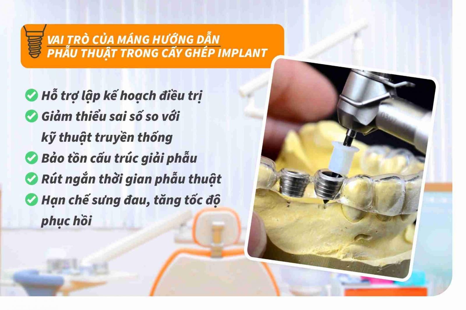 Vai trò của máng hướng dẫn phẫu thuật trong cấy ghép Implant