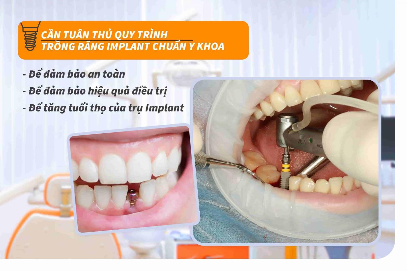 Vì sao cần tuân thủ quy trình trồng răng Implant chuẩn Y khoa?