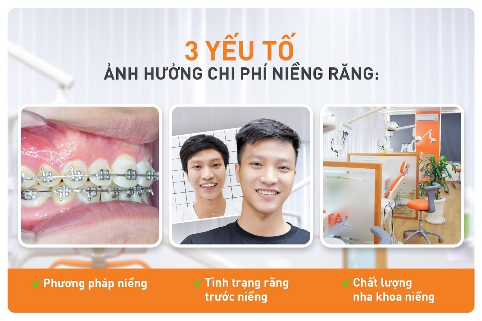 Yếu tố ảnh hưởng đến giá niềng răng mắc cài