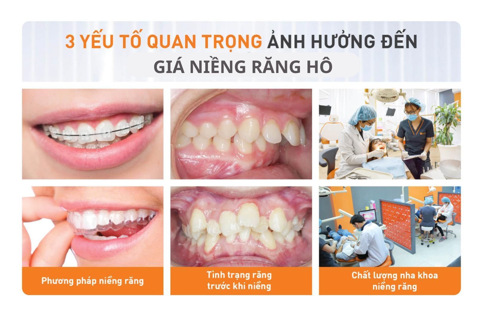 Những yếu tố ảnh hưởng giá niềng răng hô